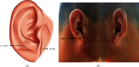Warning Function of Frank's Sign in Pre-Existing Cardiac Disease Patients: A Case Report.