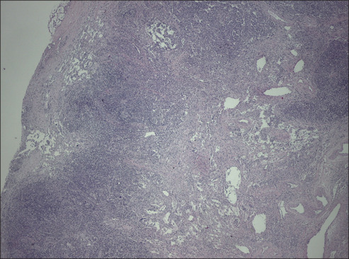 Kaposi's sarcoma immune reconstitution inflammatory syndrome: A forgotten entity nowadays.