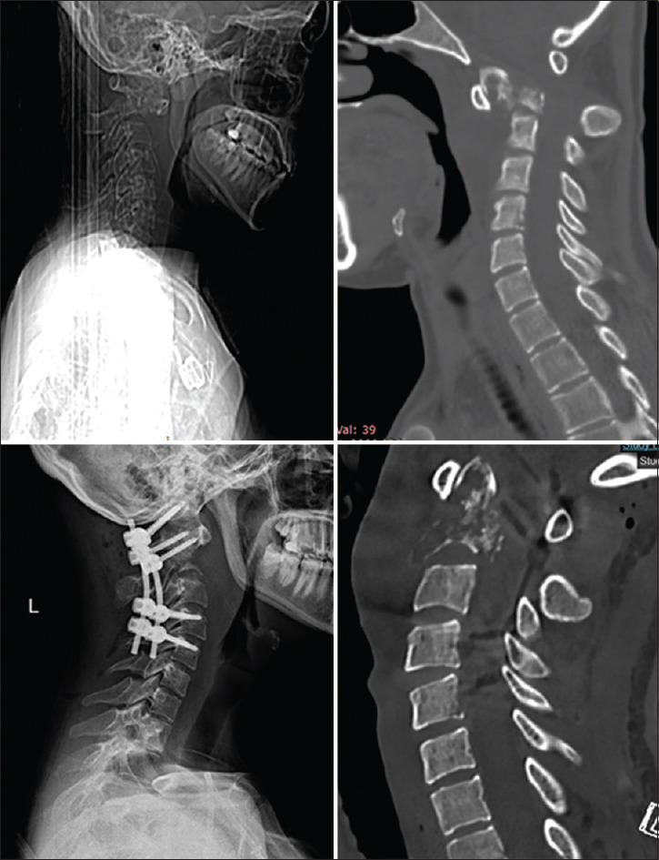 Odontoid remodeling with occipital condyle stabilization in patients with metastatic C2 involvement.