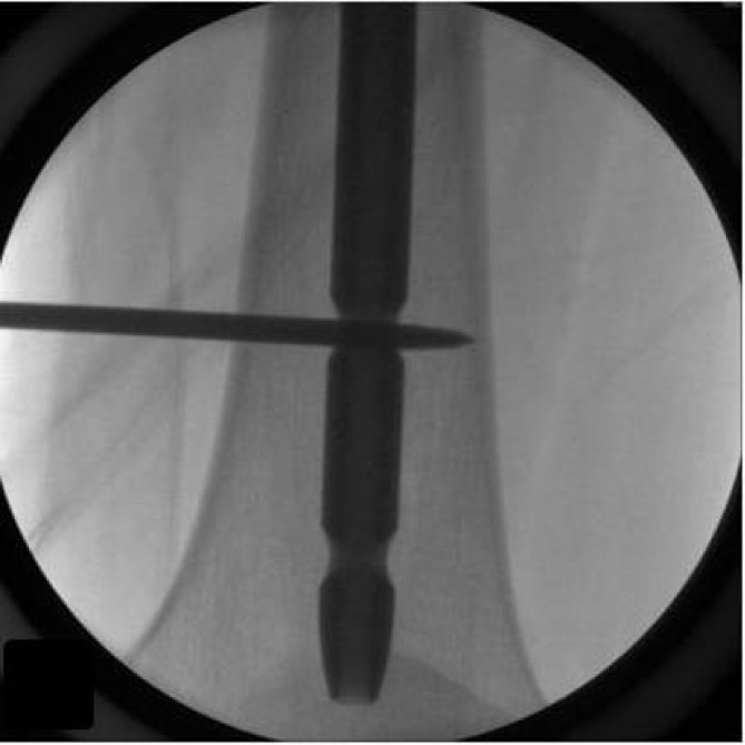 Straightforward, safe, and efficient interlocking screw insertion during intramedullary nailing using a Steinmann pin and hammer: a comparative study.