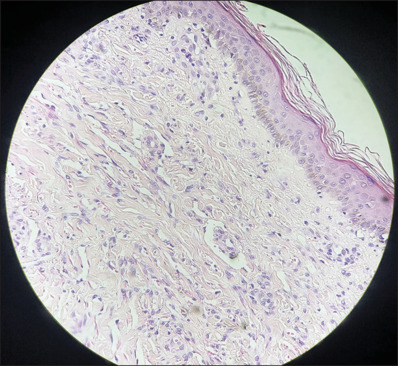 Kaposi's sarcoma immune reconstitution inflammatory syndrome: A forgotten entity nowadays.