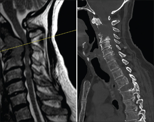 Odontoid remodeling with occipital condyle stabilization in patients with metastatic C2 involvement.