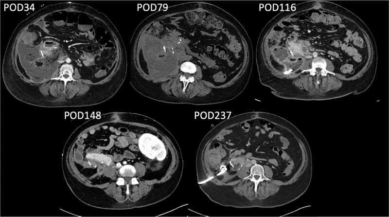 Video-assisted Retroperitoneal Debridement for Graft Pancreatitis.