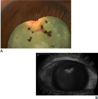 Capsular vascularization: role of suprachoroidal triamcinolone and histopathology.