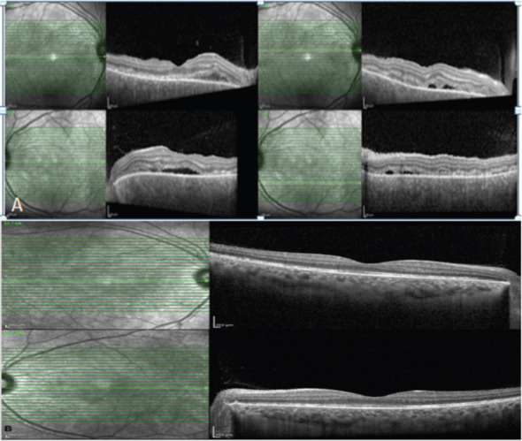 Beyond the Brain-Vogt-Koyanagi-Harada Syndrome (VKH): A Rare Brain Eye and Ear (BEE) Syndrome Presenting initially as Aseptic Meningitis- a Neurologist Perspective.