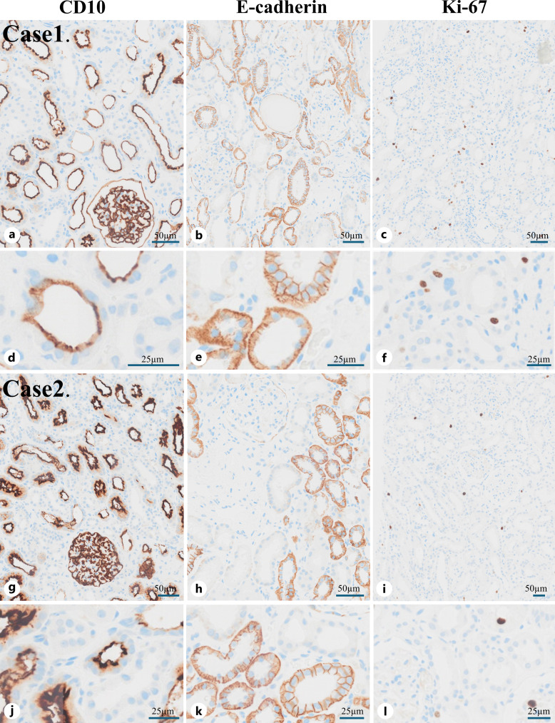 Renal Impairment of Proximal Tubular Injury Caused by Red Yeast Rice Supplement: Report of 2 Cases.
