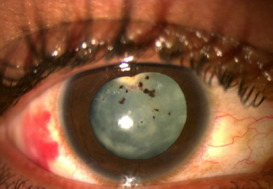 Capsular vascularization: role of suprachoroidal triamcinolone and histopathology.
