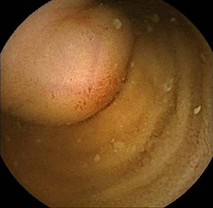 Small Bowel Bleeding Caused by a Small Bowel Lipoma in a Patient with Hemodialysis.