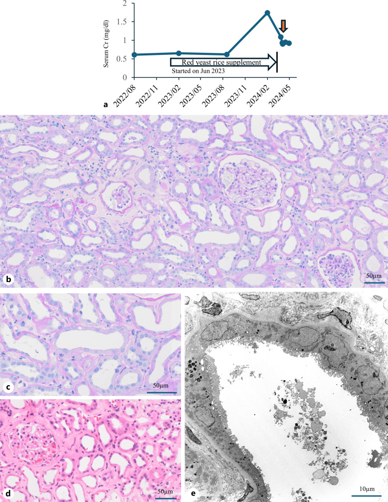 Renal Impairment of Proximal Tubular Injury Caused by Red Yeast Rice Supplement: Report of 2 Cases.
