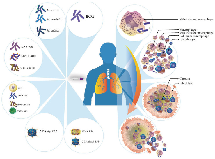 The BCG vaccine, advantages, and disadvantages of introducing new generation vaccines against <i>Mycobacterium tuberculosis</i>.