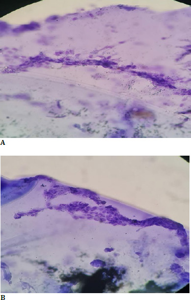 Capsular vascularization: role of suprachoroidal triamcinolone and histopathology.