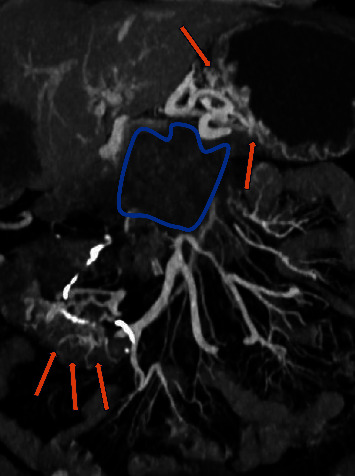 <i>Clostridium paraputrificum</i> Bacteremia and Ectopic Ileal Varices in Underlying Chronic Portal and Superior Mesenteric Vein Thrombosis: Report of a Rare Case.