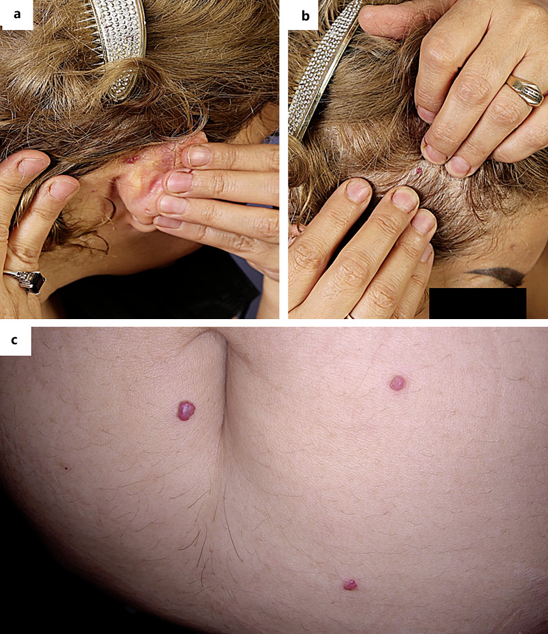 The First Case of Eruptive Pyogenic Granuloma following COVID-19 Vaccination.
