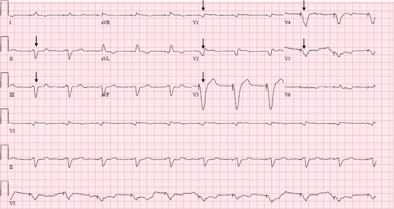 Flecainide Toxicity in a Patient with a Functioning Pacemaker.