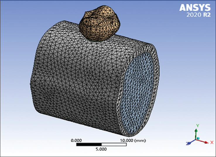 Effect of different occlusal materials on peri-implant stress distribution with different osseointegration condition: A finite element analysis.
