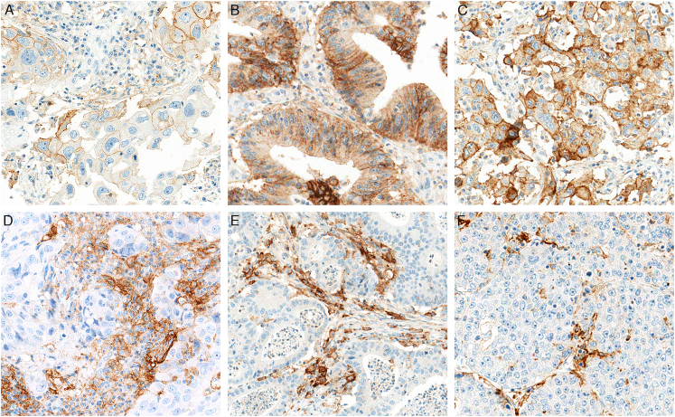 Performance Analysis of Leica Biosystems Monoclonal Antibody Programmed Cell Death Ligand 1 Clone 73-10 on Breast, Colorectal, and Hepatocellular Carcinomas.