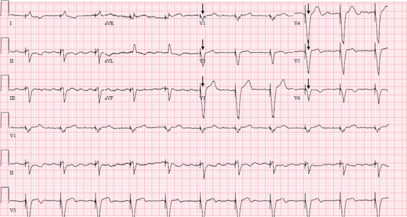 Flecainide Toxicity in a Patient with a Functioning Pacemaker.