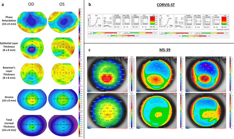 Insights into atypical segmental layer thicknesses and phase retardation in thick corneas using ultrahigh-resolution polarization-sensitive optical coherence tomography.