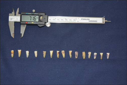 Apical and lateral accuracy of intraradicular impressions made using the indirect and direct technique at three different locations: A comparative <i>in vitro</i> analysis.