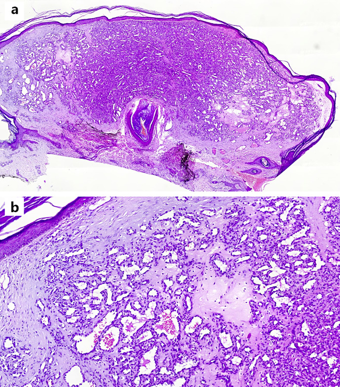 The First Case of Eruptive Pyogenic Granuloma following COVID-19 Vaccination.