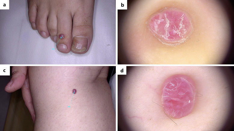 The First Case of Eruptive Pyogenic Granuloma following COVID-19 Vaccination.