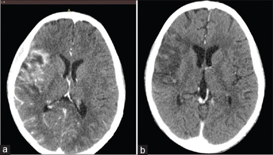 Synchronous Splenic and Intracerebral Abscesses in a Child.