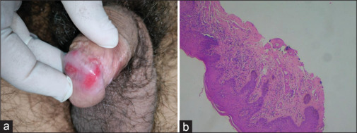 Circinate balanitis: Early manifestation of reactive arthritis? A case series.