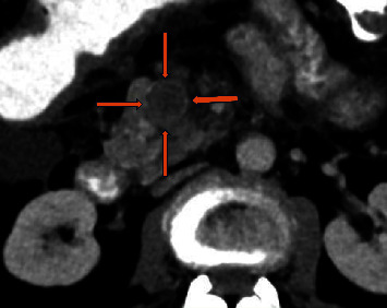 <i>Clostridium paraputrificum</i> Bacteremia and Ectopic Ileal Varices in Underlying Chronic Portal and Superior Mesenteric Vein Thrombosis: Report of a Rare Case.