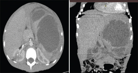 Synchronous Splenic and Intracerebral Abscesses in a Child.