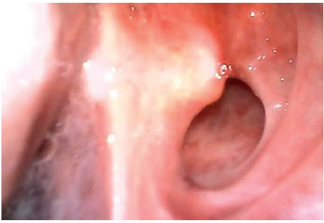 Intubation of underestimated airway in a patient with epiglottis adhesion to the posterior wall of the laryngeal cavity -A case report.