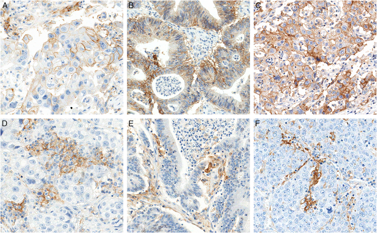 Performance Analysis of Leica Biosystems Monoclonal Antibody Programmed Cell Death Ligand 1 Clone 73-10 on Breast, Colorectal, and Hepatocellular Carcinomas.