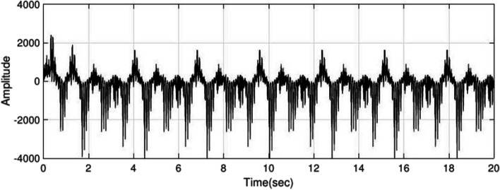 Short-term epileptic seizures prediction based on cepstrum analysis and signal morphology.