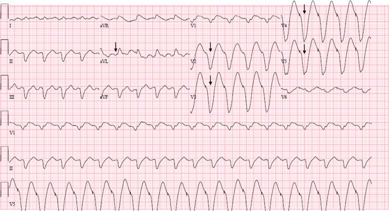 Flecainide Toxicity in a Patient with a Functioning Pacemaker.
