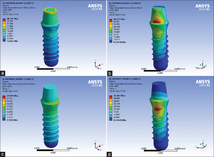 Effect of different occlusal materials on peri-implant stress distribution with different osseointegration condition: A finite element analysis.