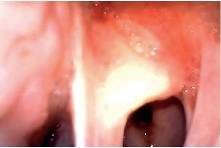 Intubation of underestimated airway in a patient with epiglottis adhesion to the posterior wall of the laryngeal cavity -A case report.