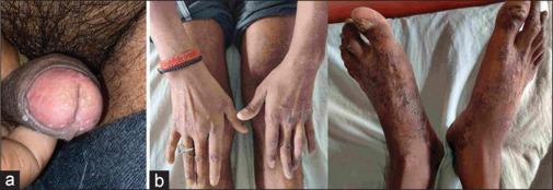 Circinate balanitis: Early manifestation of reactive arthritis? A case series.