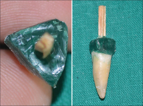 Apical and lateral accuracy of intraradicular impressions made using the indirect and direct technique at three different locations: A comparative <i>in vitro</i> analysis.