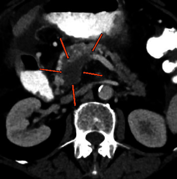<i>Clostridium paraputrificum</i> Bacteremia and Ectopic Ileal Varices in Underlying Chronic Portal and Superior Mesenteric Vein Thrombosis: Report of a Rare Case.