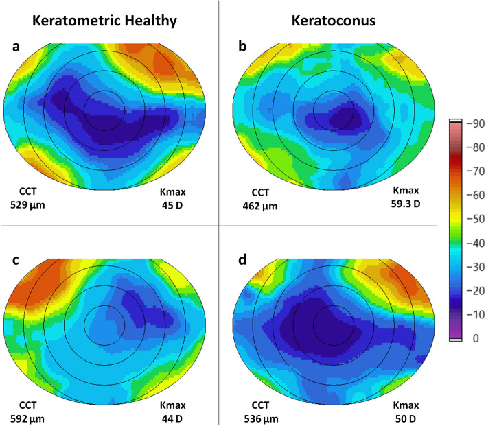 Insights into atypical segmental layer thicknesses and phase retardation in thick corneas using ultrahigh-resolution polarization-sensitive optical coherence tomography.