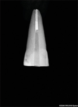 Apical and lateral accuracy of intraradicular impressions made using the indirect and direct technique at three different locations: A comparative <i>in vitro</i> analysis.
