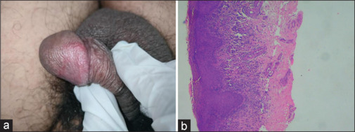 Circinate balanitis: Early manifestation of reactive arthritis? A case series.