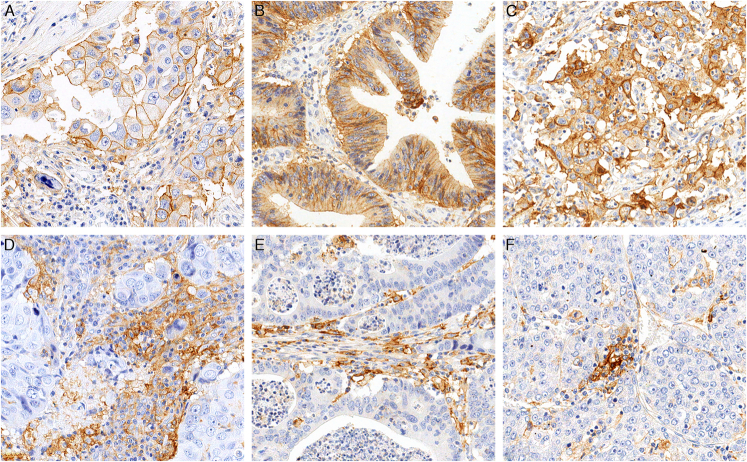 Performance Analysis of Leica Biosystems Monoclonal Antibody Programmed Cell Death Ligand 1 Clone 73-10 on Breast, Colorectal, and Hepatocellular Carcinomas.
