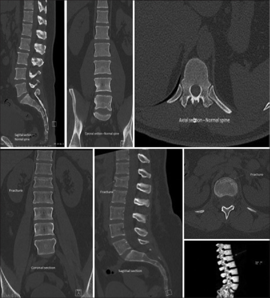 Diagnostic Clinical Tool in Trauma Patients to Rule out Thoracolumbar Fracture.