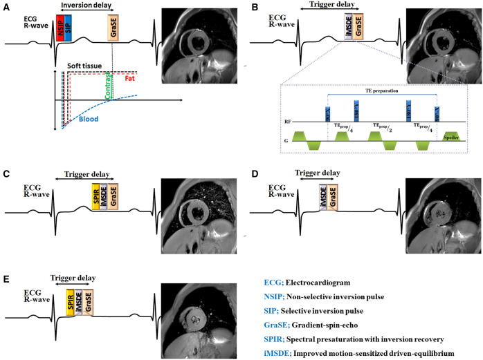 Cardiac MRI T<sub>2</sub> mapping with heart phase acquisition and improved motion-sensitized driven equilibrium blood suppression.