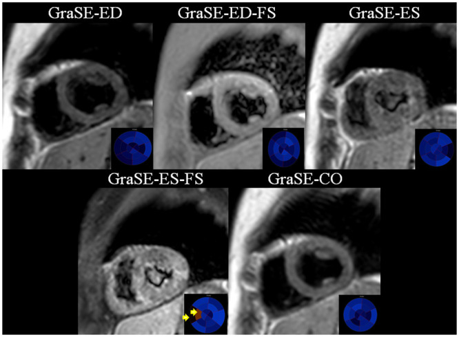 Cardiac MRI T<sub>2</sub> mapping with heart phase acquisition and improved motion-sensitized driven equilibrium blood suppression.