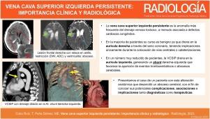 Vena cava superior izquierda persistente: importancia clínica y radiológica