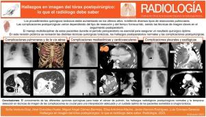 Hallazgos en imagen del tórax posquirúrgico: lo que el radiólogo debe saber