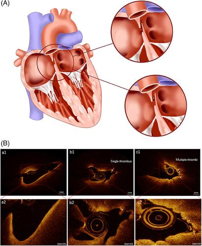 Congenital heart disease: types, pathophysiology, diagnosis, and treatment options