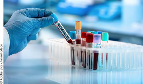 Colon cancer blood test effective for average-risk population