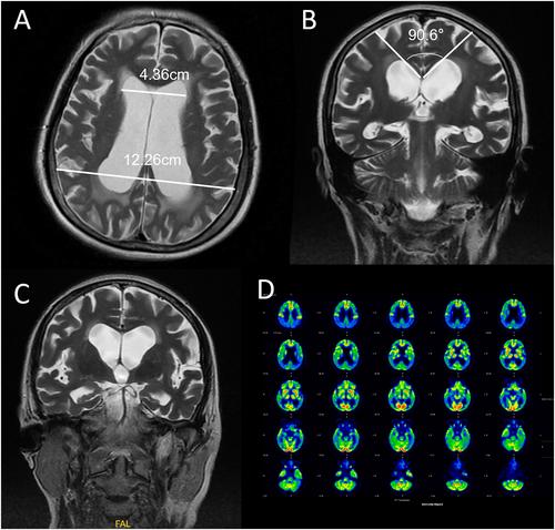 A female patient with Alzheimer's disease via multimodality diagnostic approaches: A case report